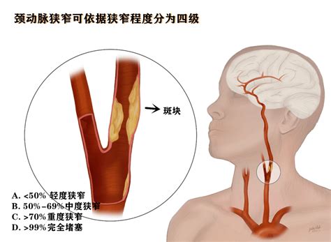 颈动脉真人图片