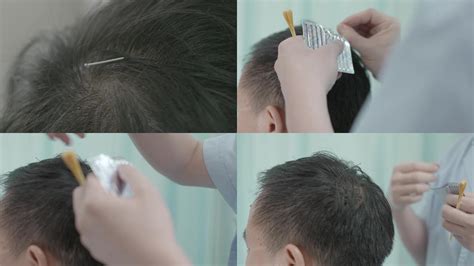 脱发怎么治疗最好 详解治疗脱发的最好方法_海南频道_凤凰网