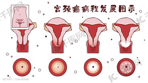 医疗人体组织器官宫颈癌科普插画图片-千库网