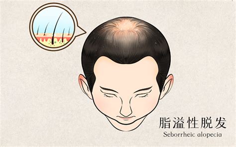 急性休止期脱发误诊为斑秃及雄激素性脱发