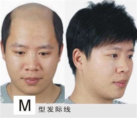 m型发际线圆寸,m型发际线发型短发,m型发际线发型_大山谷图库