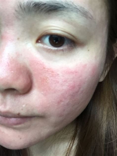皮肤红肿瘙痒、刺痛、过敏怎么办？