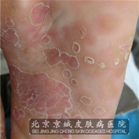 二期早发梅毒疹的症状_梅毒_北京京城皮肤医院(北京医保定点机构)