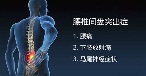 腰间盘突出图片