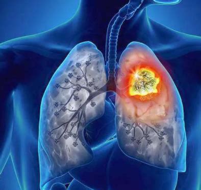 肺癌分型有妙用，这些你都知道吗？_肿瘤_医生在线
