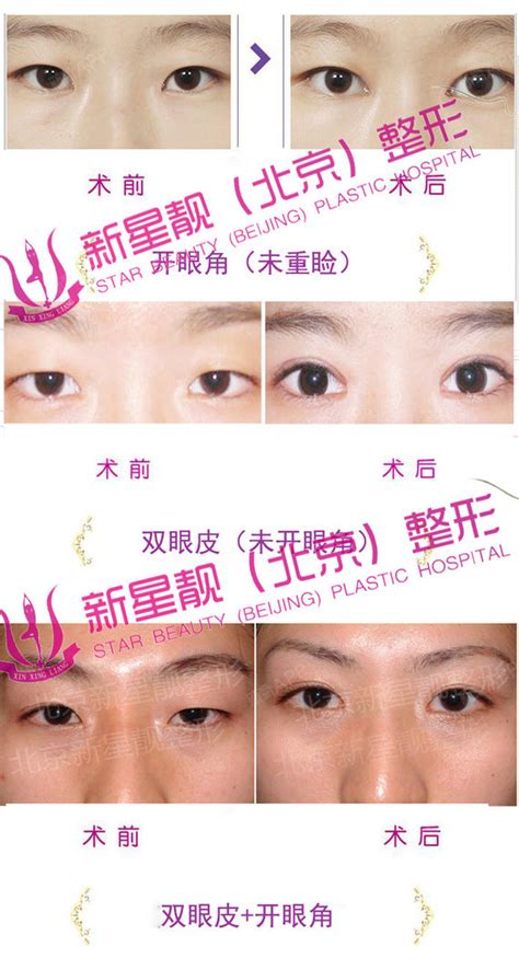 北京眼部整形医院：美莱、画美、丰联丽格割双眼皮都挺好 - 爱美容研社