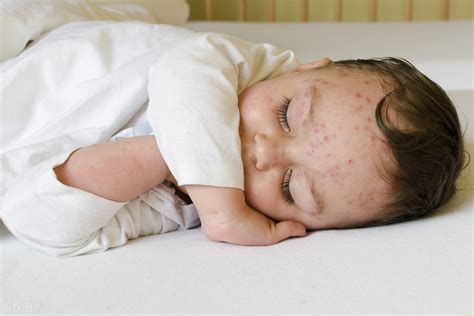 如何区别儿童水痘的症状和图片（单纯疱疹和水痘，要怎么区分？用什么药好得快？医生告诉你） | 说明书网