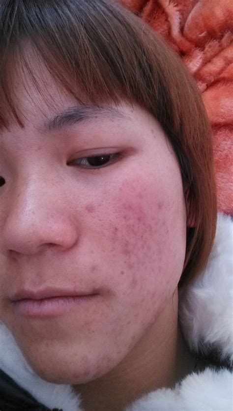 【图】左脸和右脸长痘痘的原因 8大问题揭晓还你光滑小脸蛋_伊秀美容网|yxlady.com