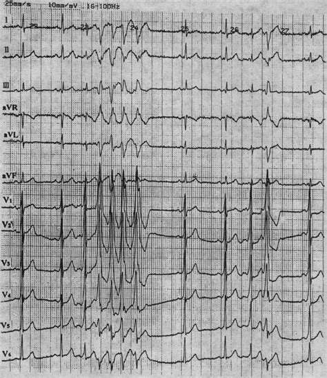 预激综合征的心电图特征-12导同步心电图-医学