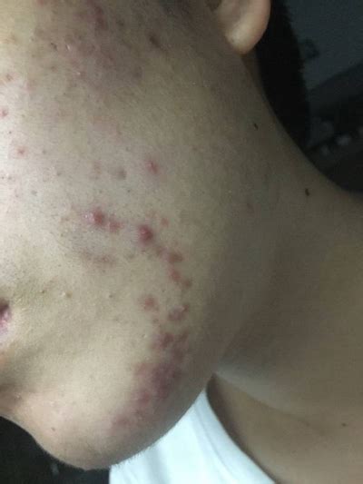 湿毒疙瘩图片