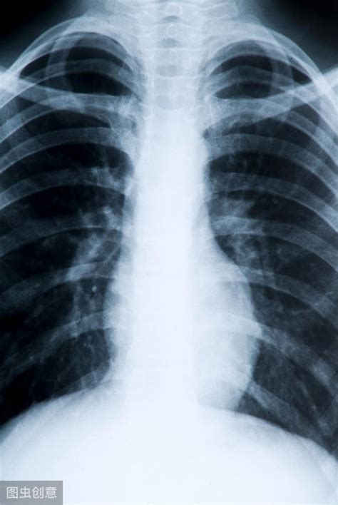 低剂量螺旋CT检查，肺癌早期诊断的“金标准”_肺部