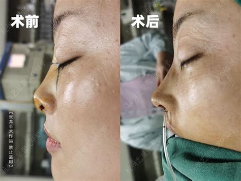 隆鼻整形也要对症下药 绝非垫高就漂亮-韩国高兰得整形外科医院-无忧爱美网整形医院