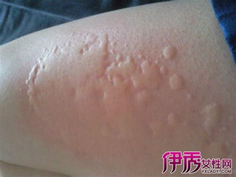 【郑州皮肤科普】荨麻疹怎么样才能快速止痒？ - 知乎