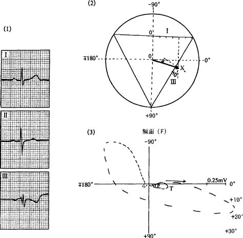 二、额面上QRS波的平均电轴(心电轴)测定法-临床心电图学及-医学