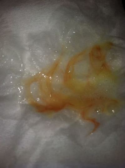 有炎症的白带图片