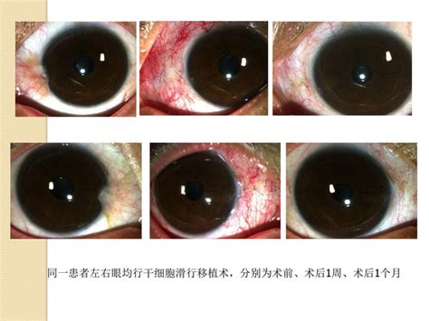 眼睛胬肉早期图片