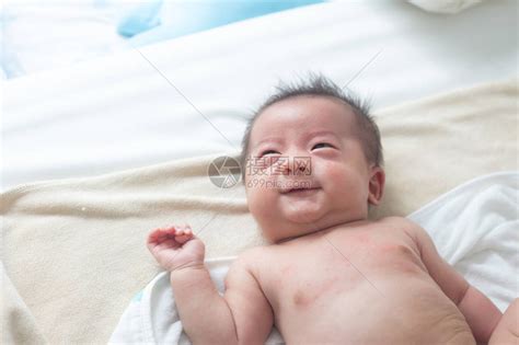 婴儿皮疹图片
