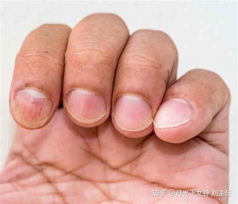 本人，女，24岁，最近突然发现我的手指甲和手指肉有分离的现象，但是又不痛不痒的，有点像烂的感觉。_百度知道