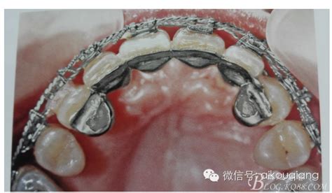 牙周夹板固定图片