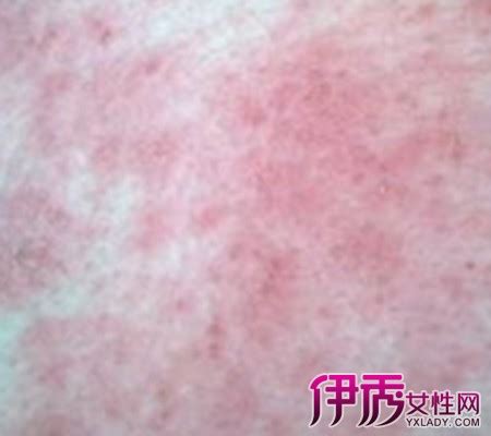 药疹过敏图图片