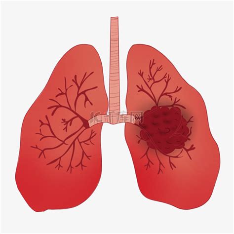 肺癌肺部疾病素材图片免费下载-千库网