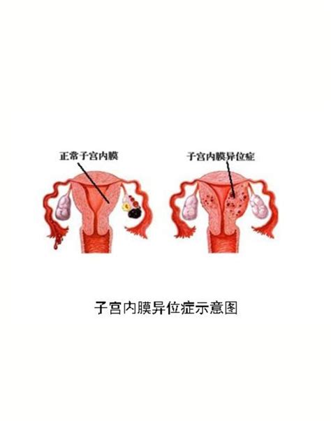 瘢痕子宫图片