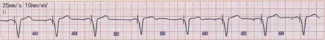 一、频率滞后-临床起搏心电图-医学