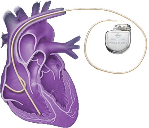 心脏启博器多少钱（十几万元一个心脏起搏器） - 羊城网