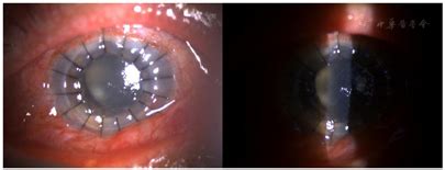 第一节 穿透性角膜移植术-眼科手术-医学