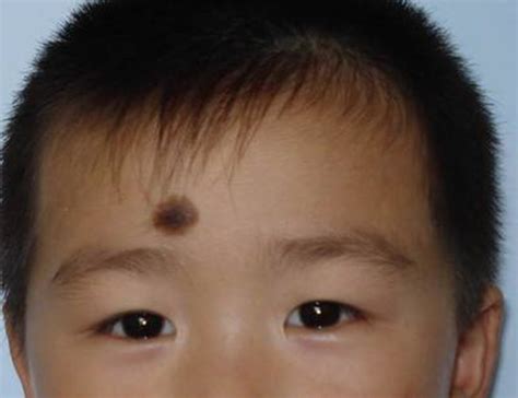 正常痣的样子图片