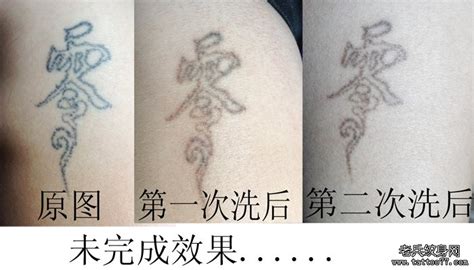 上海哪家正规医院洗纹身好的，价格多少左右？-