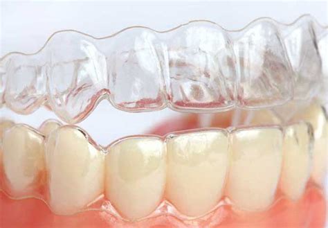 隐形牙套与传统牙套的区别
