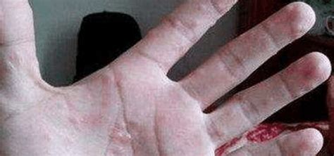 痒痒痒！姑娘手指长满小水泡还脱皮！医生：这症状夏天高发|手指|汗疱疹_新浪新闻