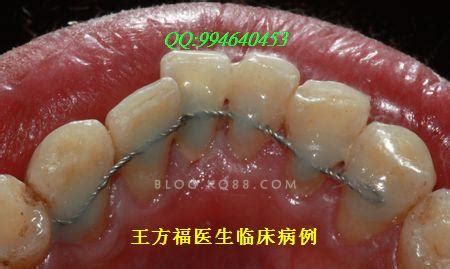 牙周夹板固定图片