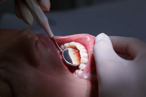 牙科镜检查的牙医的部分看法女人牙牙科口腔口腔牙齿图片下载 - 觅知网