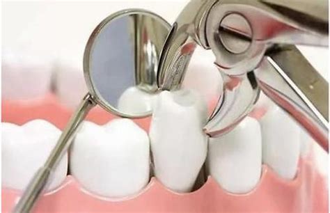 什么样的牙齿需要拔除？有哪些情况必须牙拔牙_大连口腔科普网