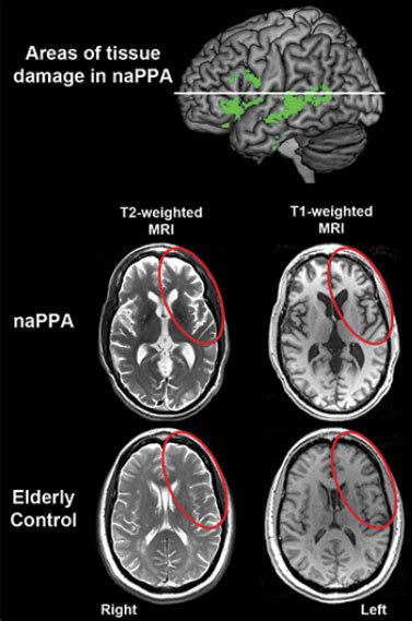 Frontotemporal dementia | The BMJ