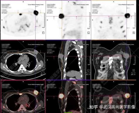 乳腺癌的15个征兆图片-乳腺肿块怎么区分良性和恶性 - 寻医问药 - 华网