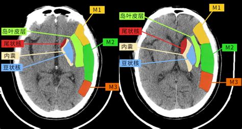 基线ASPECT评分中不同区域对AIS取栓术后临床结局预测作用的贡献不同 - 脑医汇 - 神外资讯 - 神介资讯
