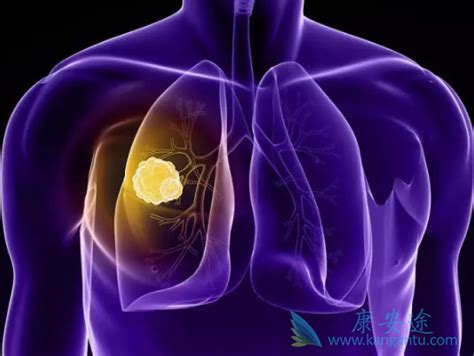 针对肺癌EGFR靶点的靶向药物有哪些？【康安途海外医疗】