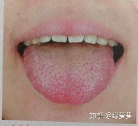 湿热舌头症状图片