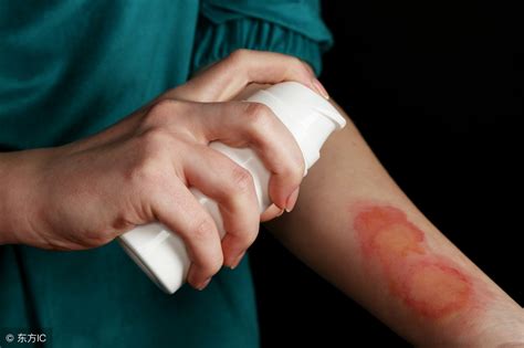 红蓝光科普系列丨摔伤、烫伤、伤口感染……家庭常见外伤还可以这样处理！
