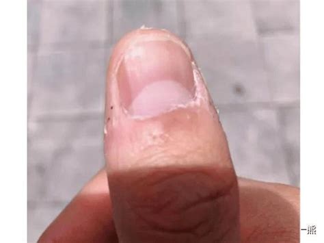 【灰指甲】外伤导致灰指甲...多久可以恢复 - 知乎