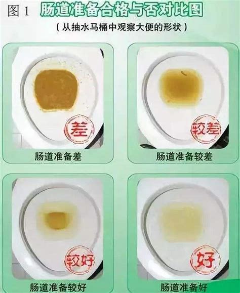肠镜术前泻药的服用方法-桂林市中西医结合医院