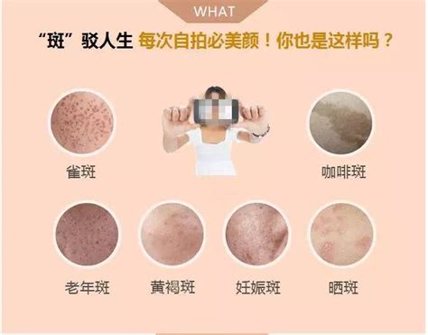 【图】皮肤病的种类有哪些 皮肤病的病因又是什么_皮肤病的种类_伊秀美容网|yxlady.com