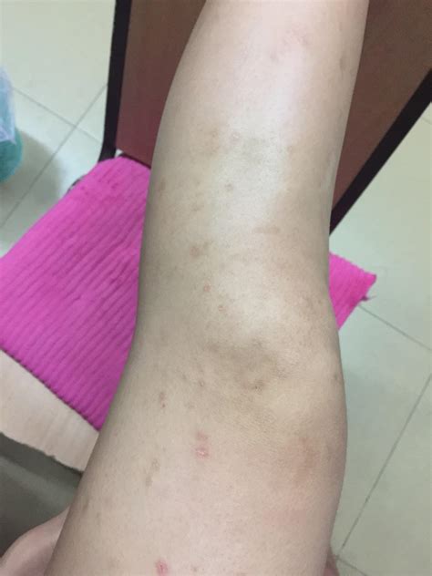 我的腿被蚊子咬得体无完肤(带图)，怎样有效地消除蚊子印？ - 知乎