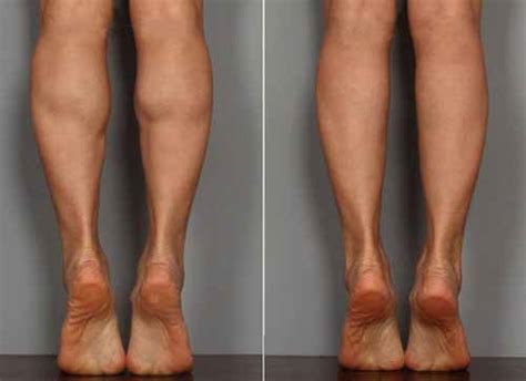 小腿粗怎么减 肌肉型小腿的瘦腿方案-【减肥百科网】