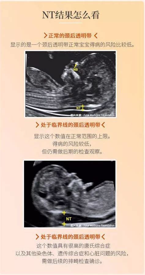 什么是NT检查：孕妈咪一定要懂的第一次胎儿排畸！ | 孕育百科 | 广州爱博恩妇产医院,广州爱博恩官方网站,广州高端妇产医院,爱博恩医学月子服务