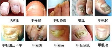 灰指甲早期怎样治疗-灰指甲治疗-复禾健康