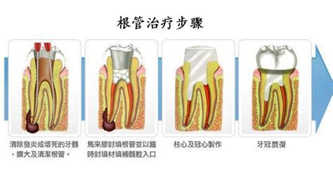 成都根管治疗多少钱一颗牙?大牙和显微镜根管治疗价格不同,牙齿修复-8682赴韩整形网